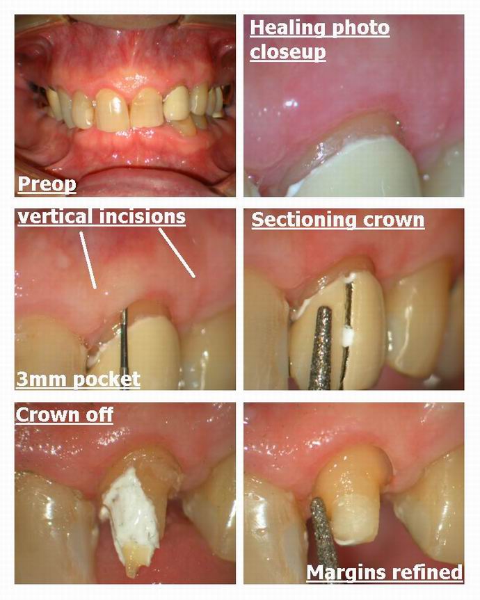 Resize of Crown prep Collage pg 1.jpg